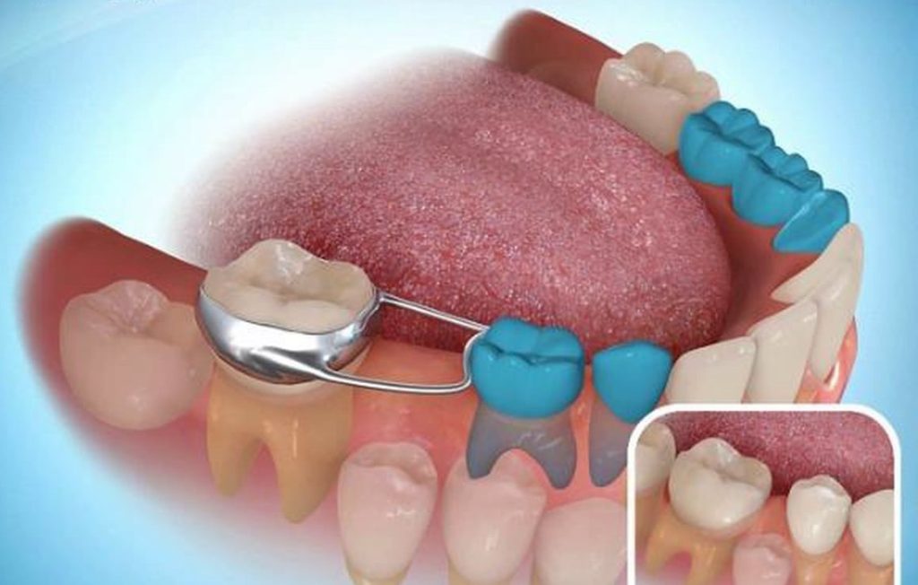 Space Maintainers for Baby Teeth