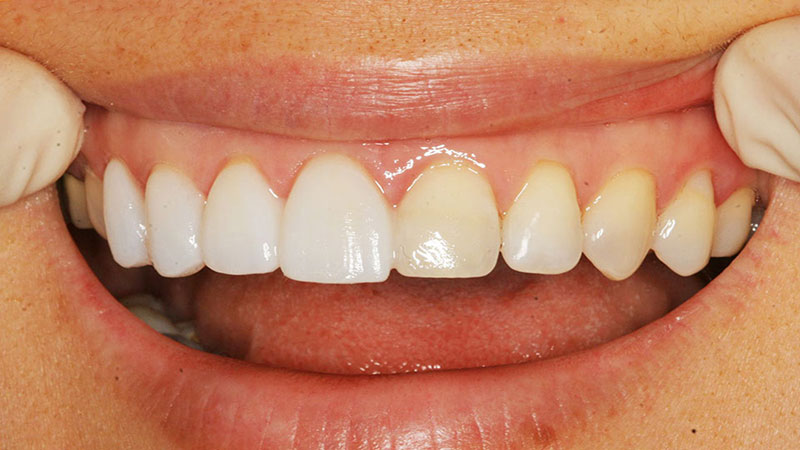 لمینت دندان لومینیرز چیست؟