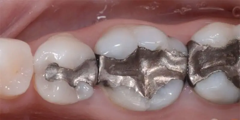 پرکردن دندان چه مراحلی دارد