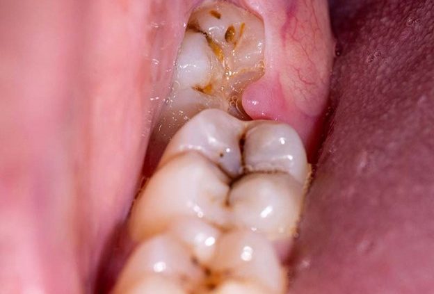 چرا دندان عقل نهفته می شود