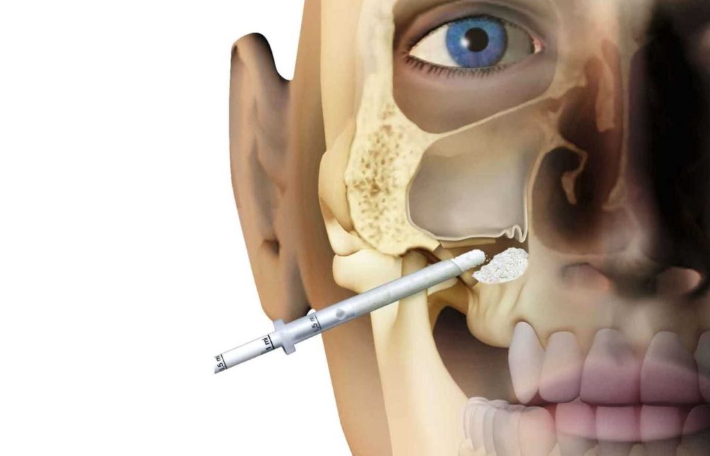 لیفت سینوس چیست؟